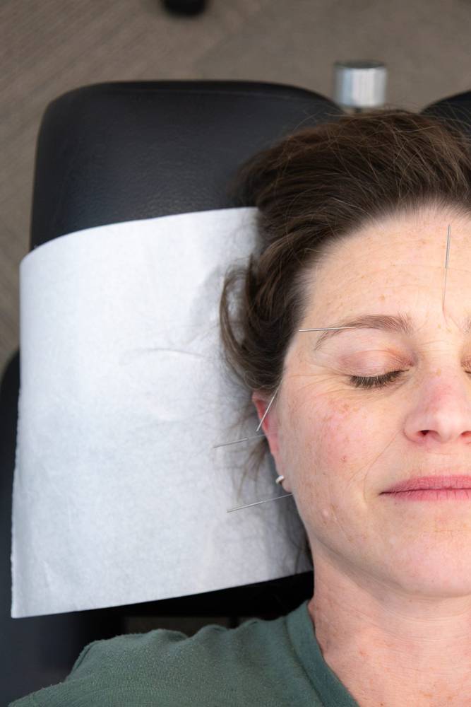 A relaxed patient resting during an acupuncture treatment