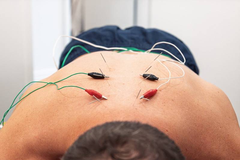 Electro-acupuncture needles with small clips placed along a patient’s upper back